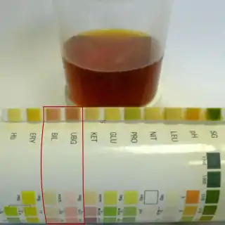 Orina con aspecto de cola por coluria.