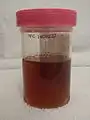 Orina rojo-oscura por sangre, en la hematuria.