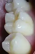 Plexodoncia